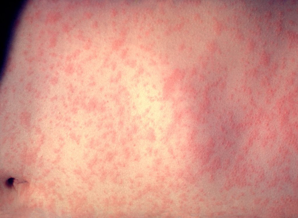 A skin rash is observed on a patient's abdomen 3-days after the onset of a measles infection. The image was captured at New York Hospital-Cornell Medical Center in 1958. Photo by Heinz F. Eichenwald, MD /CDC Public Health Image Library.
