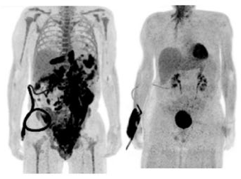 Novel CAR-T Cell Immunotherapy for Lymphoma Advances to Phase II Clinical Trial