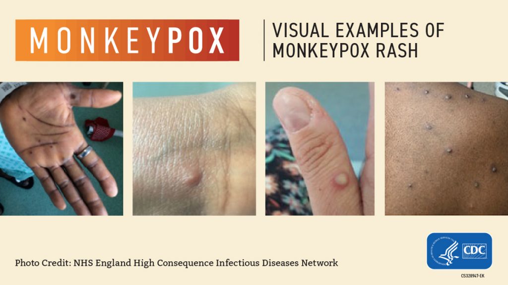 Visual examples of Monkeypox rash. Photo Credit: NHS England High Consequence Infections Diseases Network