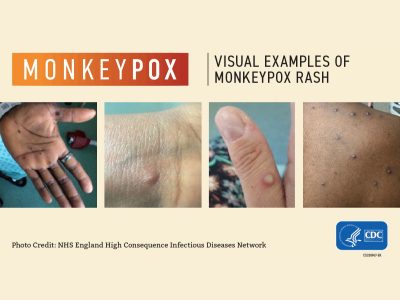 Wisconsin Has First Case of Monkeypox